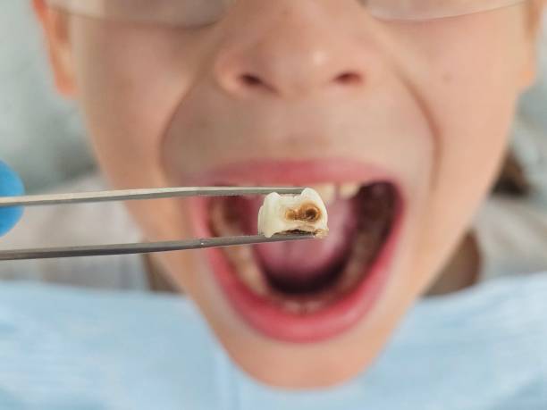 Best Emergency Dentist for Knocked-Out Tooth in North Merrick, NY